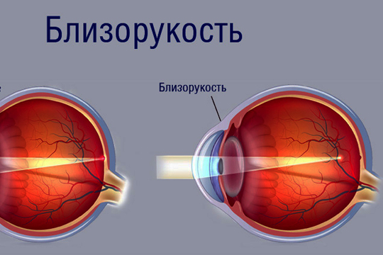 Миопия, пресбиопия и лазерная коррекция