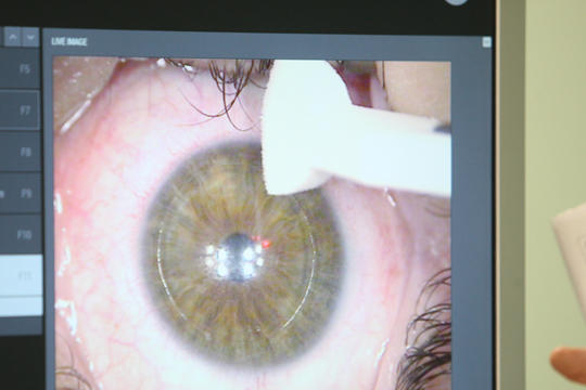 Лазерная коррекция астигматизма: методика и результаты