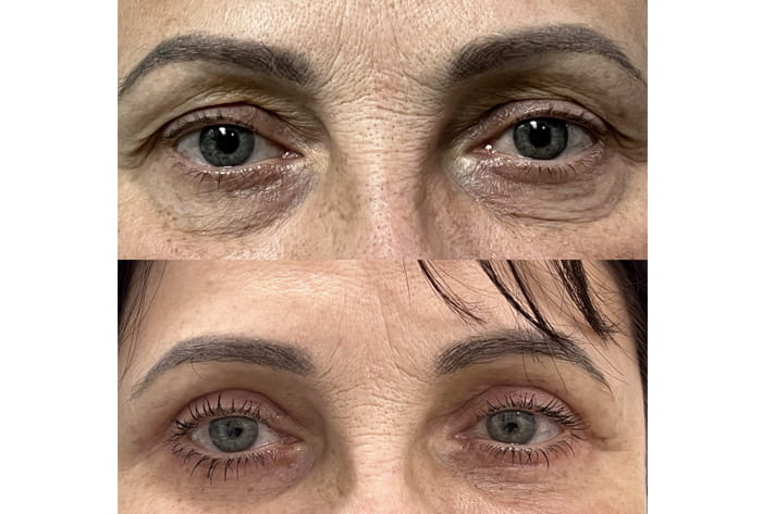 коррекция дерматохалазиса верхних и нижних век