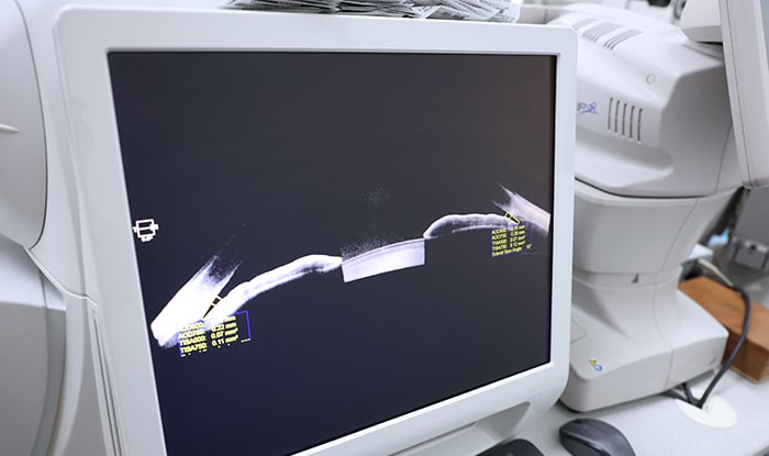 Оптическая когерентная томография (ОКТ) — золотой стандарт диагностики ЦХРД.