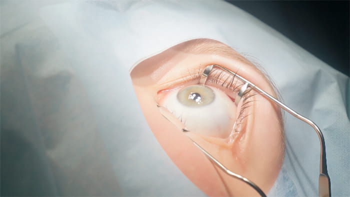 ласик видео