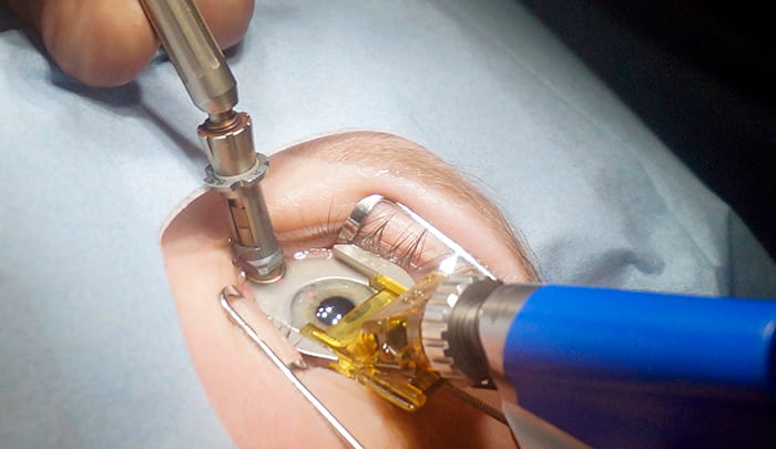 ласик цена ласик цена