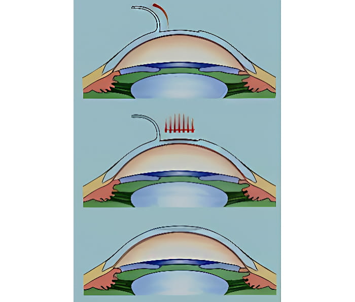 узнайте на операцию Лазик стоимость на&nbsp;нашем сайте