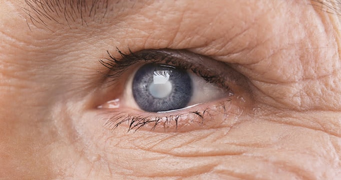 Начальная катаракта— первая стадия патологического процесса помутнения хрусталика