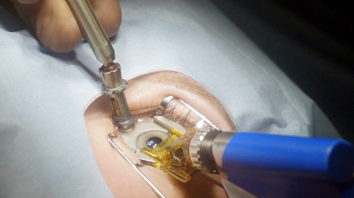 последствия операции Ласик немногочисленны