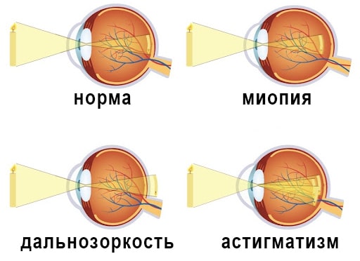 миопия схема миопия