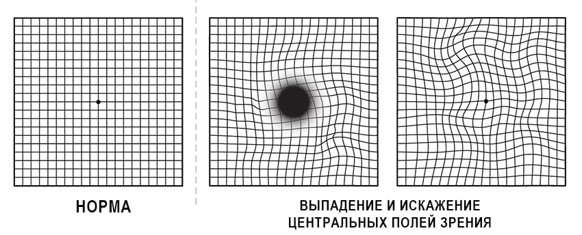 Тест Амслера