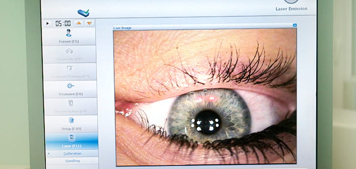 методы лазерной коррекции зрения