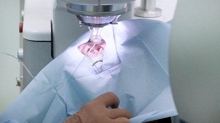 При ФемтоЛасик формирование роговичного лоскута осуществляется при помощи фемтосекундного лазера.