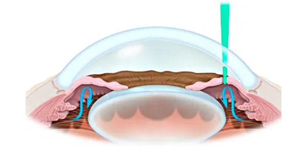 иридэктомия