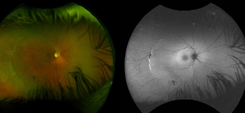 Ретиношизис глаза представляет собой офтальмологическое заболевание, связанное с дегенеративными изменениями в сетчатке Ретиношизис глаза представляет собой офтальмологическое заболевание, связанное с дегенеративными изменениями в сетчатке