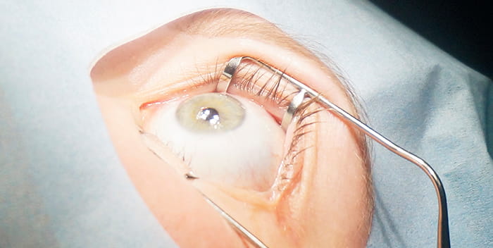 лазерная коррекция lasik