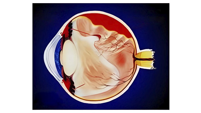 лечение отслойки сетчатки