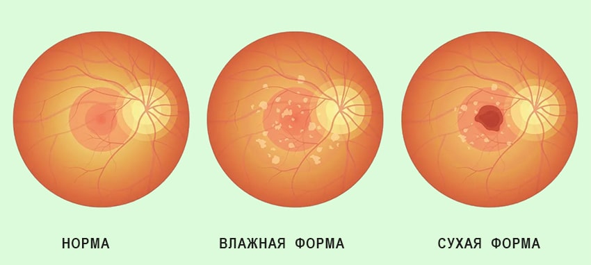Существует несколько разновидностей болезни, которая протекает в несколько стадий.