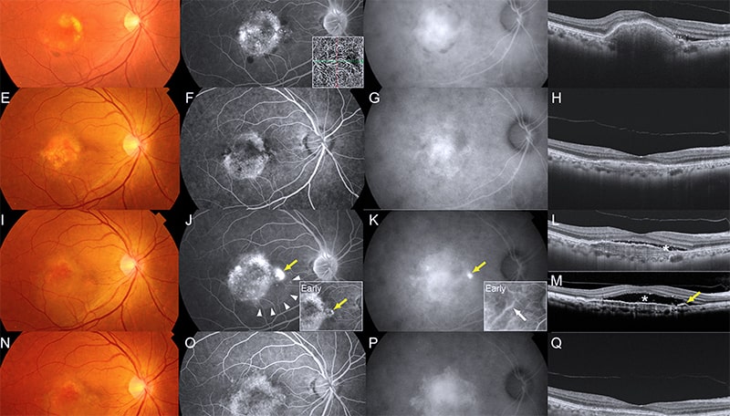 Центральная хориоретинопатия