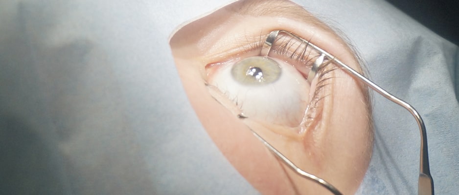 Операции ЛАСИК дают возможность без существенного отрыва от привычной жизни вернуть стопроцентное зрение Ласик
