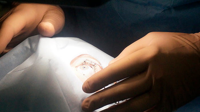 лазик после операции лазик после операции