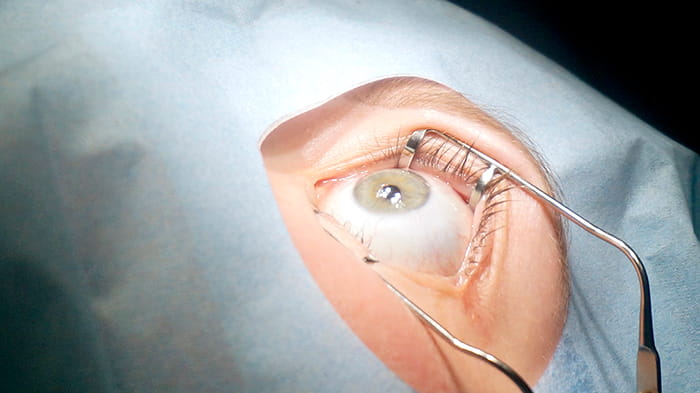 ласик противопоказания ласик противопоказания