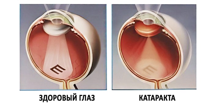 Катаракта хрусталика