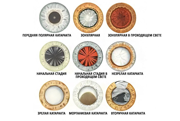 катаракта стадии