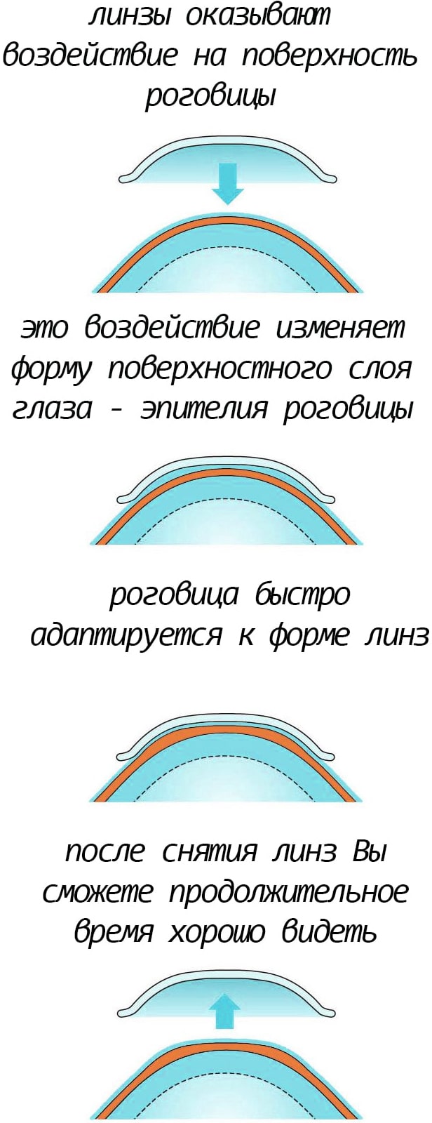 Астигматизм глаз - причины, риски, методы лечения и лазерная коррекция