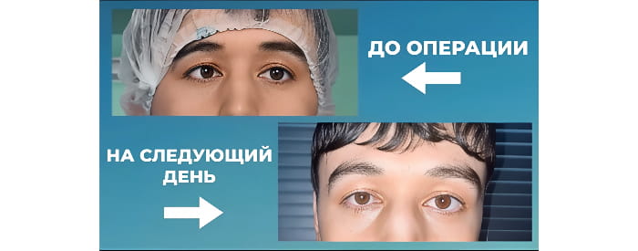 Оба глаза в норме должны фокусироваться в единой точке