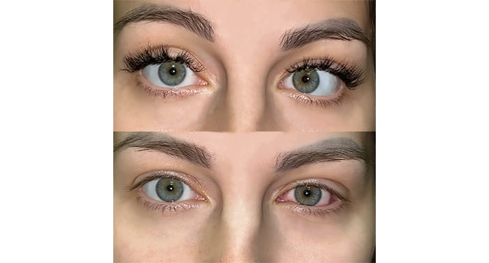 Результат после операции по поводу косоглазия