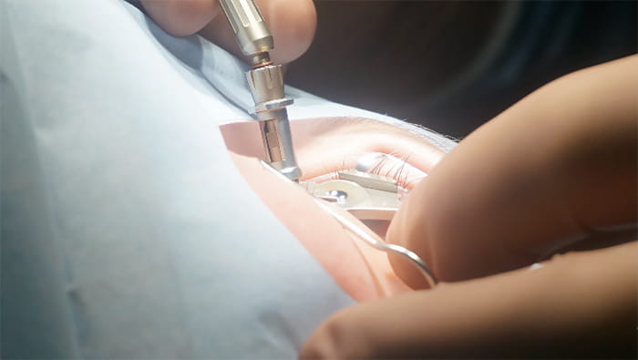 лазерная коррекция: последствия операции