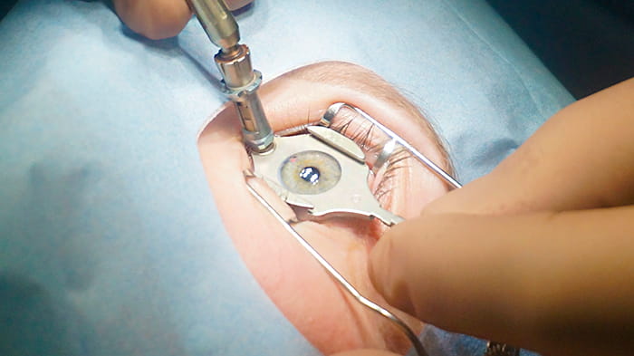 коррекция дальнозоркости