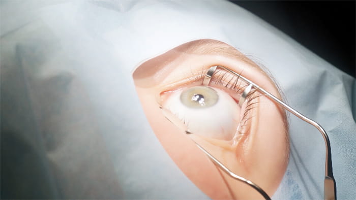 лазерная операция ласик
