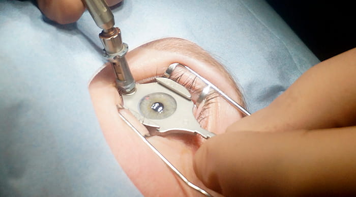 В ходе лазерной коррекции зрения методом Ласик в Москве используется специализированный прибор, который называется микрокератом