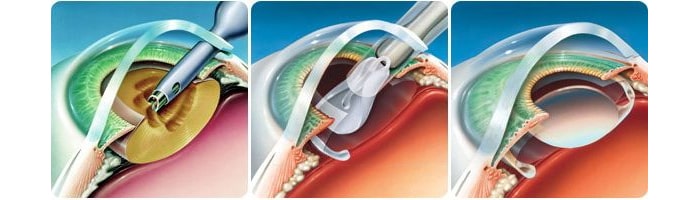 имплантация линзы, заменяющей хрусталик удаление катаракты