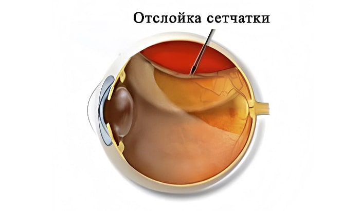 отслойка сетчатки глаза