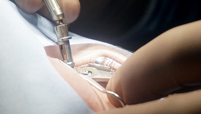 Ласик позволяет прооперировать оба глаза в один день. Ласик позволяет прооперировать оба глаза в один день.