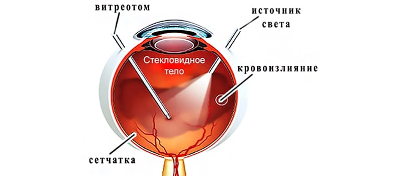 Витрэктомия – это частичное или полное удаление стекловидного тела глаза хирургическим путем.