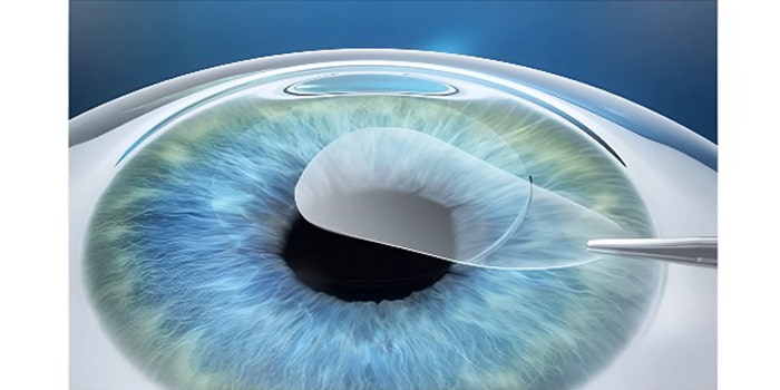 SMall Incision Lenticula Extraction(SMILE) Метод коррекции зрения путём удаления лентикулы через малый разрез