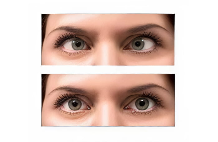 косоглазие у&nbsp;взрослых