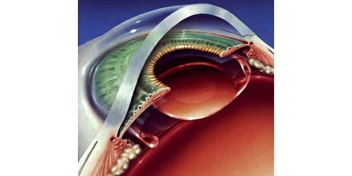 Все имплантируемые у нас в клинике монофокальные ИОЛ являются мягкими, что позволяет имплантировать их в глаз через минимальный прокол