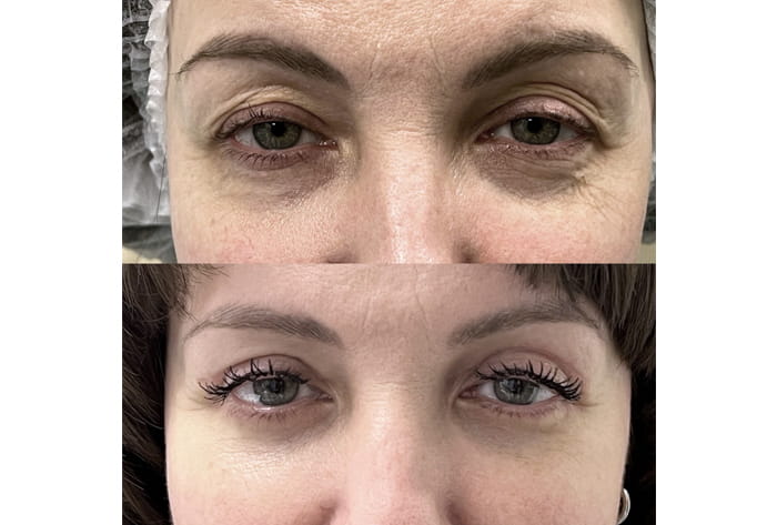 Коррекция дерматохалазиса верхних и нижних век