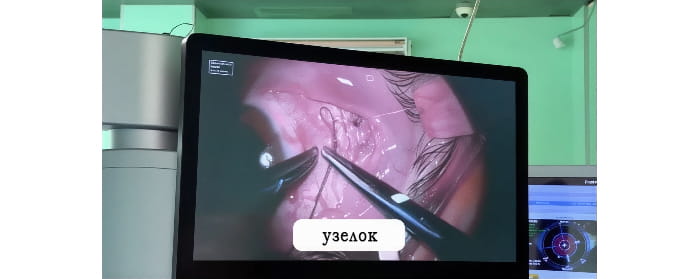 процедура лечения косоглазия у&nbsp;взрослых