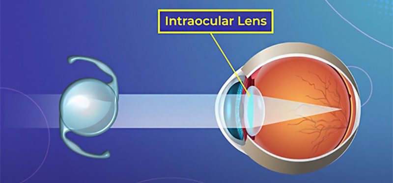 Окончательное решение о возможности проведения операции принимается только после полного обследования и консультации с врачом.
