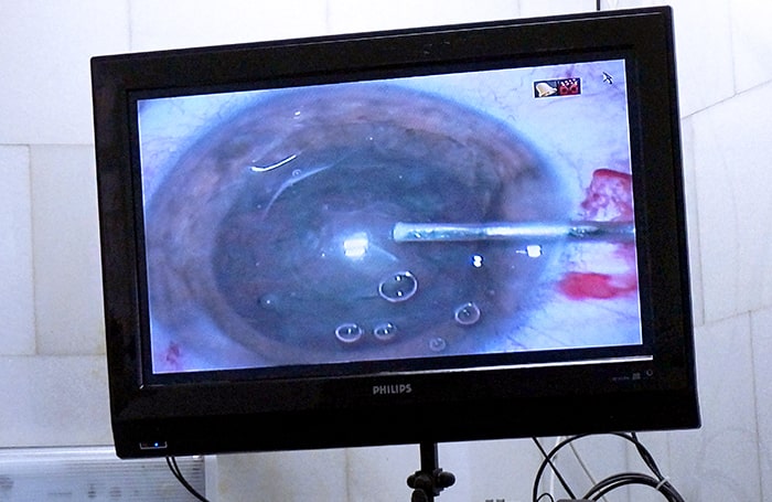 операция по удалению катаракты – серьёзное хирургическое вмешательство