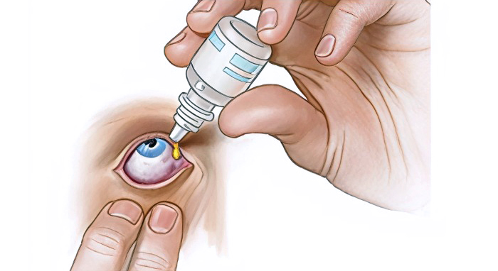 Схема — как закапывать глазные капли. Схема — как закапывать глазные капли.
