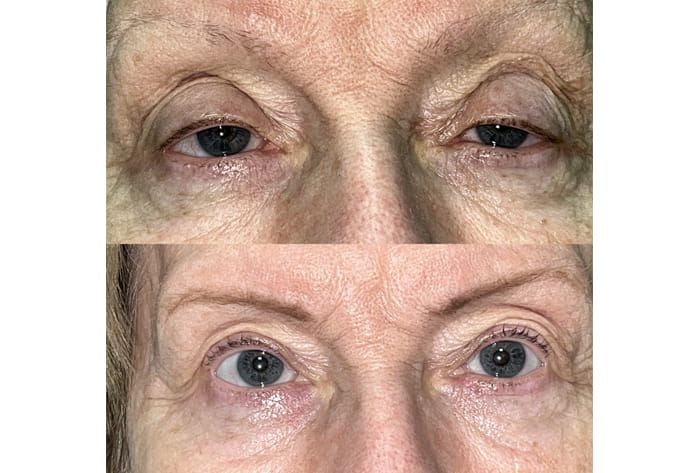 коррекция птоза (опущения) верхних век