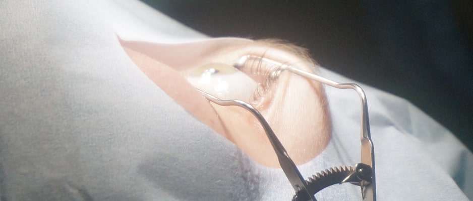 Ласик позволяет восстановить зрение при астигматизме, близорукости и дальнозоркости Ласик