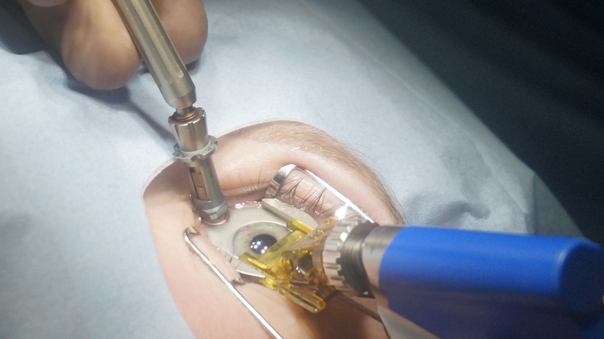 Коррекция близорукости