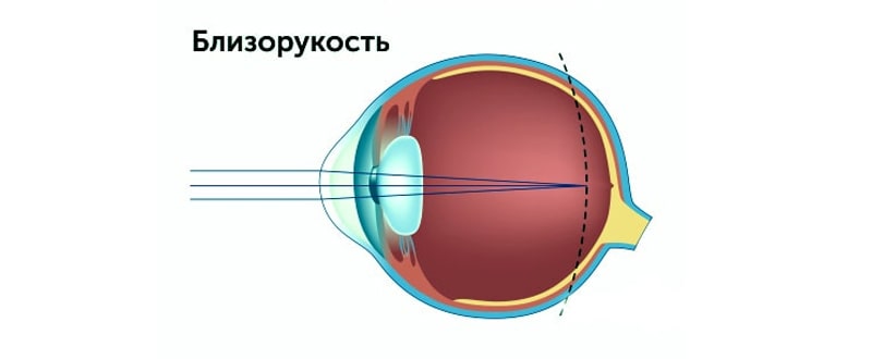 Чем больше степень близорукости, тем больше длина глаза, тем выше риск осложнений. Чем больше степень близорукости, тем больше длина глаза, тем выше риск осложнений.