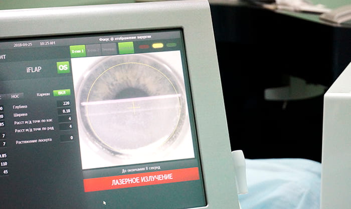 лазерная коррекция зрения осложнения