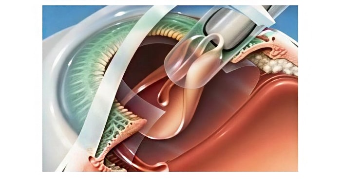 Замена хрусталика