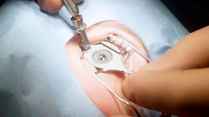операция Ласик – осложнения немногочисленны